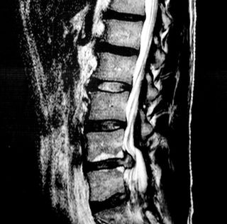 Spinal fusion
